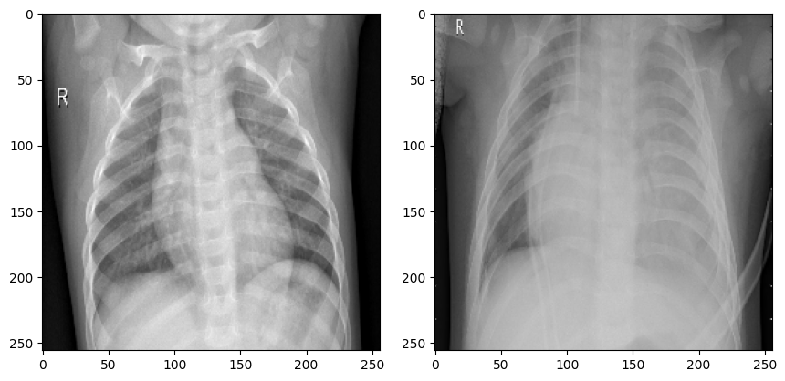 normal-vs-pneumonia-X-ray